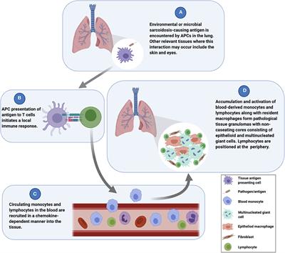 Current Sarcoidosis Models and the Importance of Focusing on the Granuloma